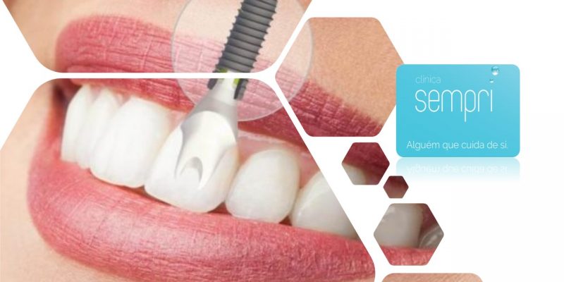 Sempri Tenho Implantes Dentários e agora!?? Notícias - SEMPRI