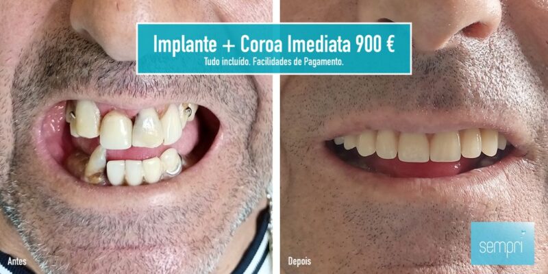 Implante + Coroa Imediata 900 €