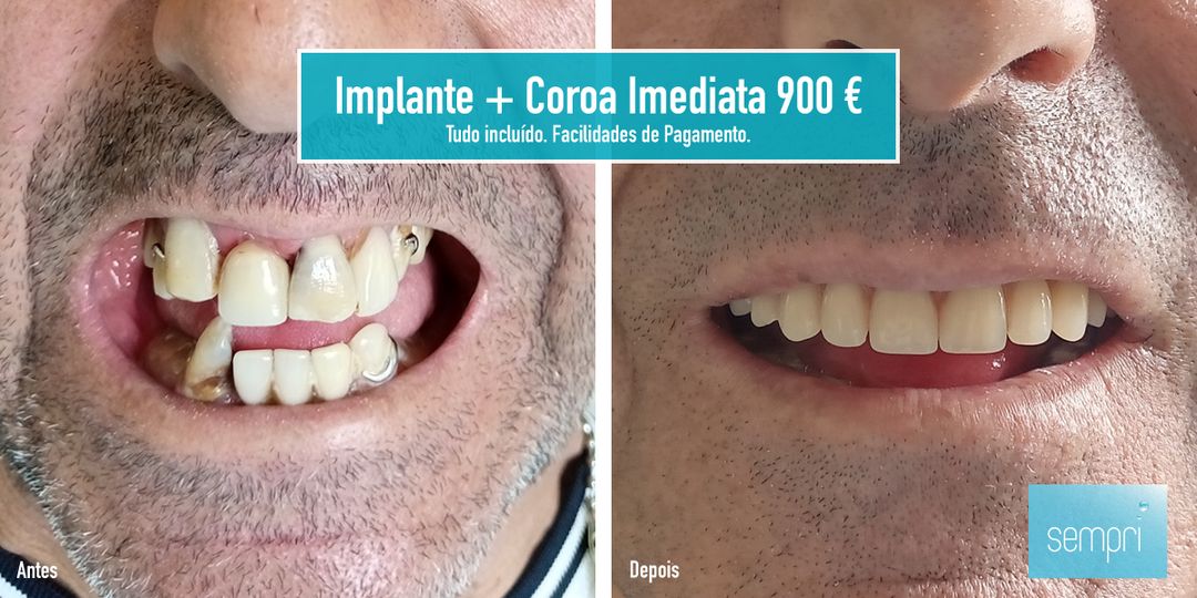 Sempri Implante + Coroa Imediata 900 € Promoções - SEMPRI
